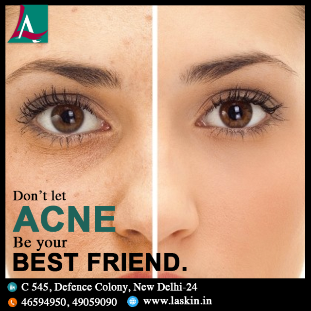 Best Acne Scar Treatment In Delhi India